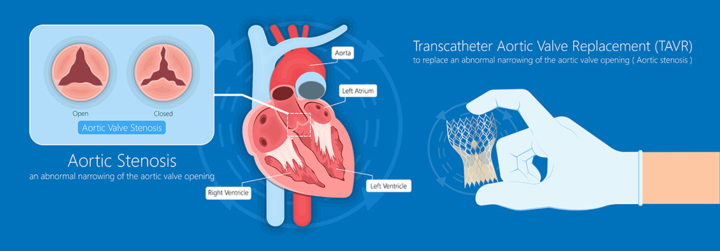 TAVR